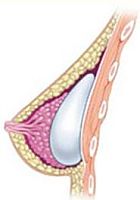 rysunek-implant-2