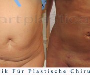 Fettabsaugung - 1 Tag nach der Operation - Artplastica - Beauty Group 