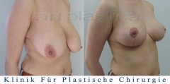 Brustverkleinerung -  Bilder vor und nach der Operation