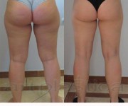  Fettabsaugung (Liposuktion) - Beauty Group - Artplastica