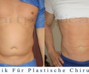  Fettabsaugung (Liposuktion) - Beauty Group - Artplastica