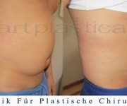  Fettabsaugung (Liposuktion) - Beauty Group - Artplastica