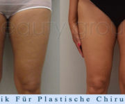  Fettabsaugung (Liposuktion) - Beauty Group