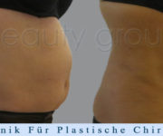  Fettabsaugung (Liposuktion) - Beauty Group