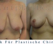 Beauty Group-Artplastica -Brustreduktion - 2 Monate nach der Operation
