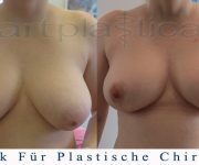 Beauty Group - Artplastica - Brustreduktion