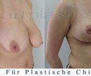 Brustverkleinerung