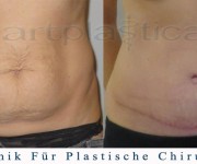 Bauchdeckenstraffung - vorher, nachher bilder - Beauty Group - Artplastica