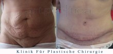 Bauchdeckenstraffung - vorher, nachher bilder