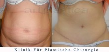 Bauchdeckenstraffung - vorher, nachher bilder