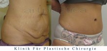 Bauchdeckenstraffung - vorher, nachher bilder