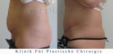 Bauchdeckenstraffung - vorher, nachher bilder
