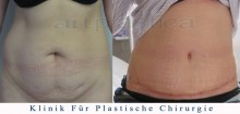 Bauchdeckenstraffung - vorher, nachher bilder