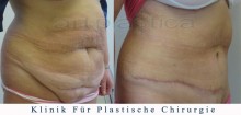 Bauchdeckenstraffung - vorher, nachher bilder