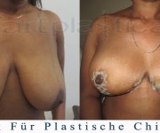 Brustreduktion - ein paar Tage nach der Operation - Beauty Group