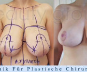 Brustverkleinerung - 2 Monate nach der Operation - Beauty Group