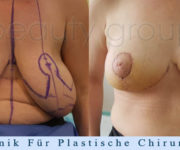 Brustverkleinerung - Beauty Group