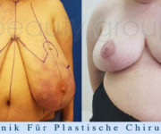 Brustverkleinerung - Beauty Group