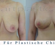 Brustreduktion - ein paar Tage nach der Operation - Beauty Group