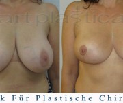 Brustverkleinerung
