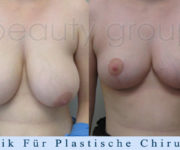 Brustverkleinerung - 2 Monate nach der Operation - Beauty Group