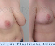 Brustverkleinerung - 2 Monate nach der Operation - Beauty Group