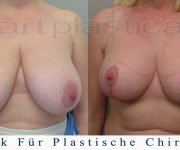 Brustverkleinerung - 6 Wochen nach der Operation