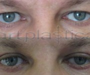 Augenliderkorrektur nachher und vorher photos galerie