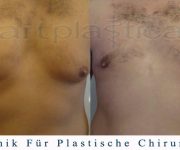 Gynäkomastie - männlich Brustverkleinerung - Bilder vor und nach der Operation - Beauty Group Polen