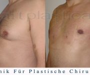 Gynäkomastie - männlich Brustverkleinerung - Bilder vor und nach der Operation - Beauty Group Polen