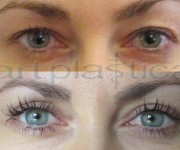 Augenliderkorrektur nachher und vorher photos galerie
