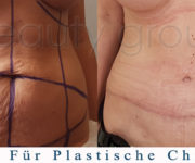 Bauchdeckenstraffung - vorher, nachher - Beauty Group - Artplastica