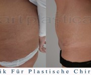 Bauchdeckenstraffung - vorher, nachher bilder - Beauty Group - Artplastica