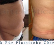 Bauchdeckenstraffung - vorher, nachher bilder - Beauty Group - Artplastica