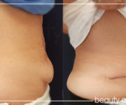 Abdominoplastyk