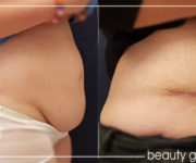 Abdominoplastyk