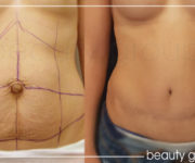 Abdominoplastyk