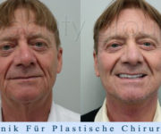 Augusto Moschini - Facelifting und Halslifting