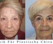 Beauty Group - Artplastica - facelifting, augenliderkorrektur