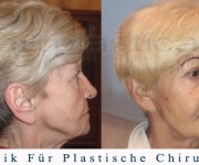 Beauty Group - Artplastica - facelifting, augenliderkorrektur