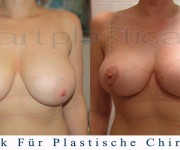 Bruststraffung (nach 2 monaten) - Beauty Group - Artplastica