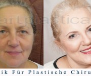 Beauty Group - Artplastica - facelifting, augenliderkorrektur