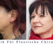Beauty Group - Artplastica - facelifting, augenliderkorrektur