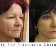 Beauty Group - Artplastica - facelifting, augenliderkorrektur