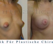 Brustvergroesserung mit brustplastik