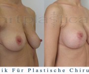 Brustvergroesserung mit brustplastik - Beauty Group - Artplastica