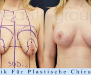 Brustvergroesserung mit brustplastik - Beauty Group
