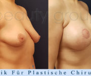 Brustvergroesserung mit brustplastik - Beauty Group