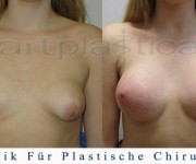 Brustvergrößerung (Asymmetrie) galerie vor und nach der Operation 