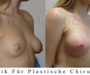 Brustvergrößerung (Asymmetrie) galerie vor und nach der Operation 